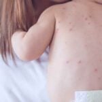 Bambino con bolle da morbillo