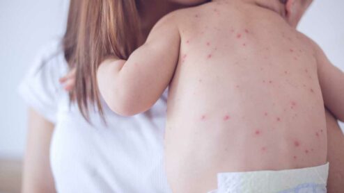 Come trovare vaccino x morbillo?