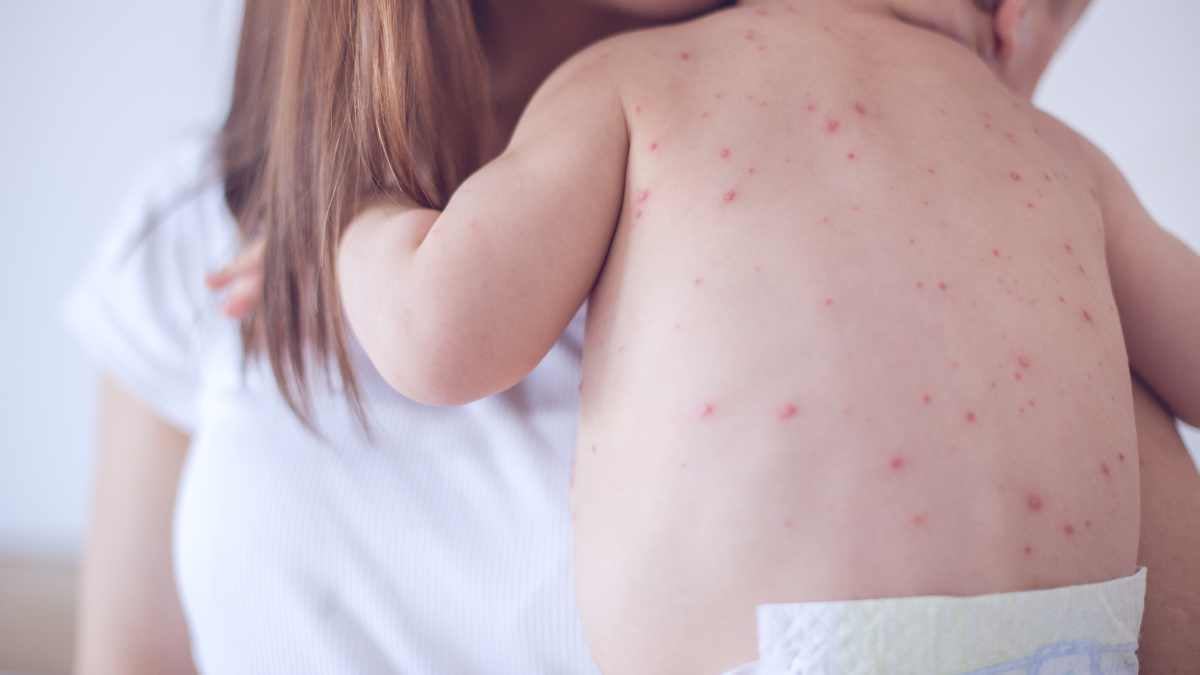 Bambino con bolle da morbillo