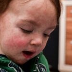 Bambino con faccia ricoperta dalle bolle del morbillo