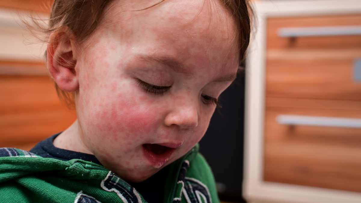 Bambino con faccia ricoperta dalle bolle del morbillo