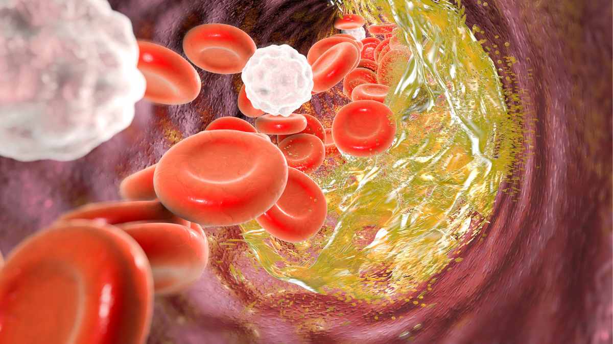 Cholesterol - Destruction of atheromatous plaque inside blood vessel