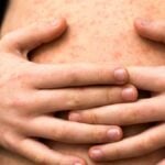 Corpo di ragazzo colpito da morbillo