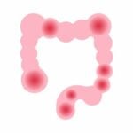 IBS colon