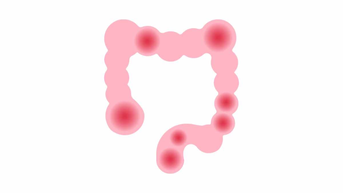 IBS colon crohn