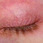 Eyelid with atopic dermatitis, itchy rash, redness