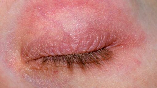 Eyelid with atopic dermatitis, itchy rash, redness
