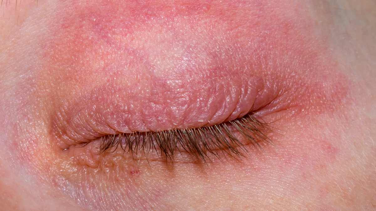 What kind of allergies cause skin rash?