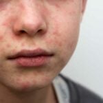 Faccia di bambino colpito da morbillo