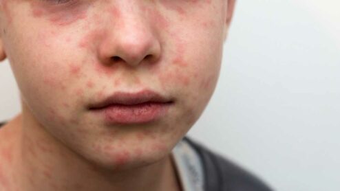 Who eradicazione morbillo?