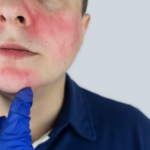 Les - lupus eritematoso sistemico. Osservazione