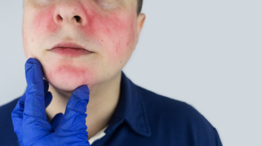 Les - lupus eritematoso sistemico. Osservazione