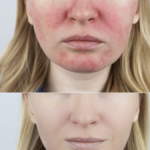 Les - lupus eritematoso sistemico. faccia sana vs. faccia colpita