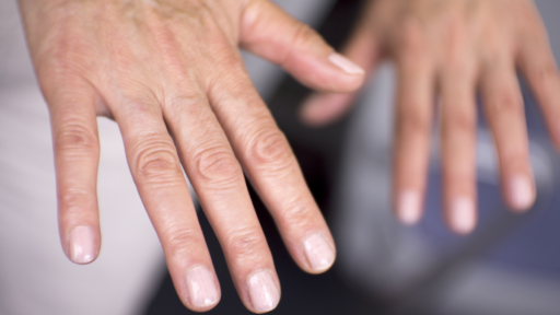 Les - lupus eritematoso sistemico. mani