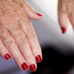Les - lupus eritematoso sistemico. particolare di mani