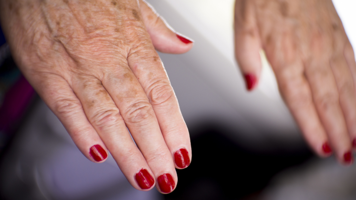 Les - lupus eritematoso sistemico. particolare di mani