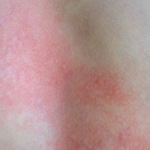 Les - lupus eritematoso sistemico. pelle segnata