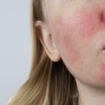 Les - lupus eritematoso sistemico. rossore facciale