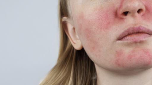 Les - lupus eritematoso sistemico. rossore facciale