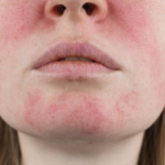 Les - lupus eritematoso sistemico. tracce sul viso