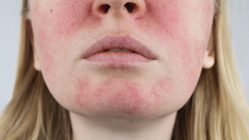 Les - lupus eritematoso sistemico. tracce sul viso
