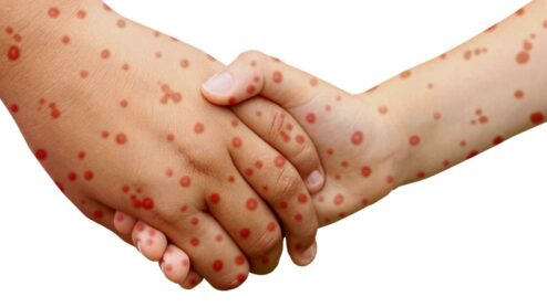 Quanti morti da morbillo statistiche?
