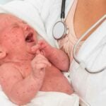 Neonato colpito da morbillo