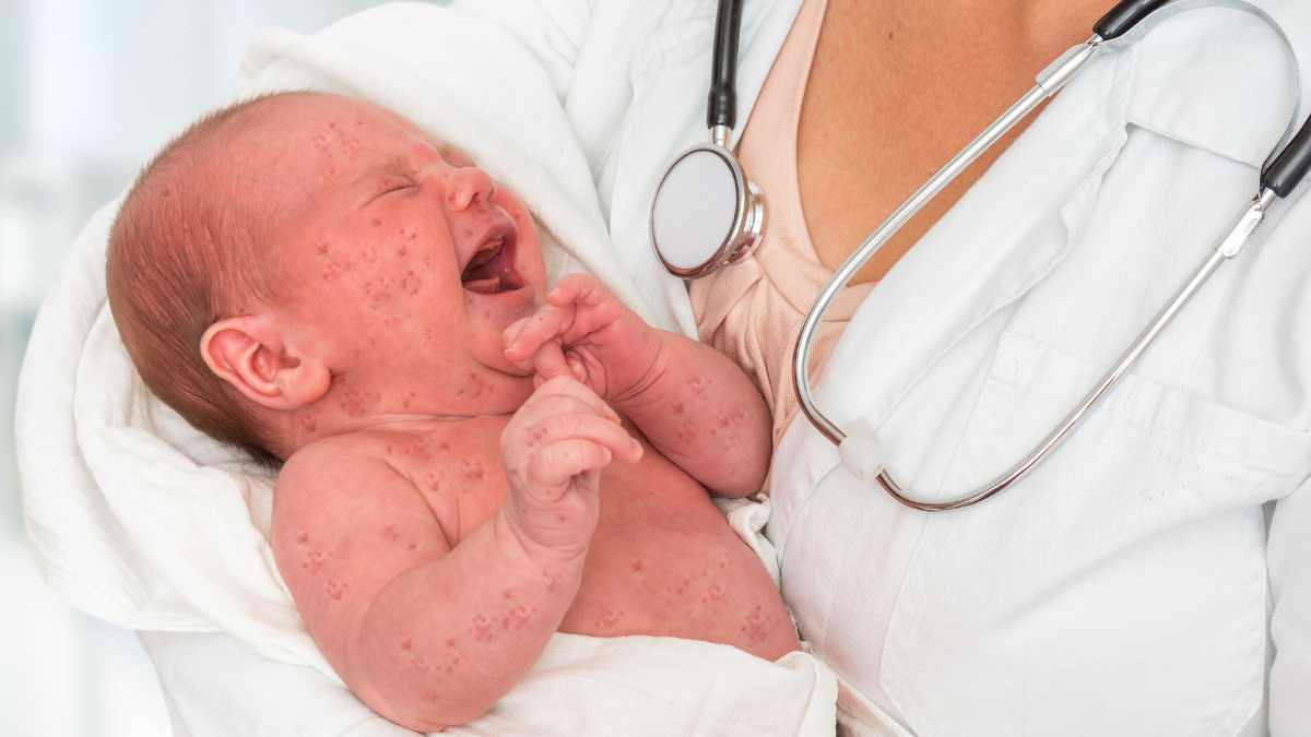 Quale copertura dopo vaccinazione contro il morbillo?