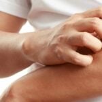 Nickel allergy - arm irritation
