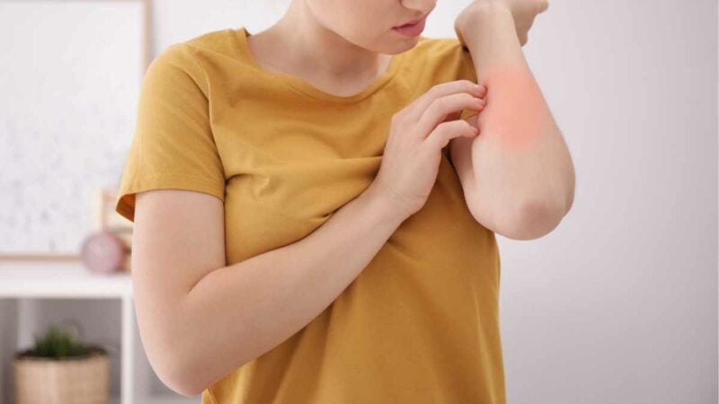Nickel allergy - girl scratching her arm