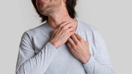 Nickel allergy - man with severe neck irritation