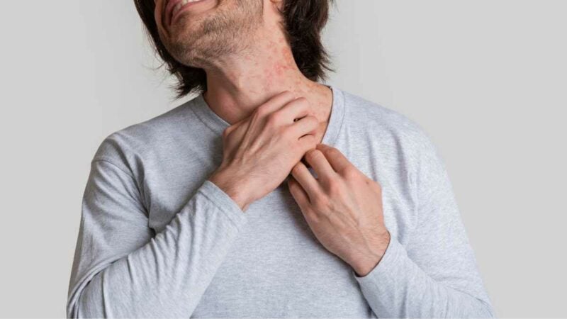 Nickel allergy - man with severe neck irritation