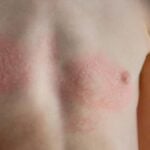 Nickel allergy - severe chest irritation