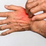 Nickel allergy - severe hand irritation