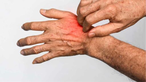 Nickel allergy - severe hand irritation
