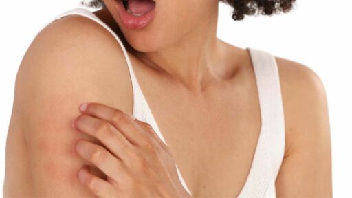 Nickel allergy - woman with severe itching on shoulder