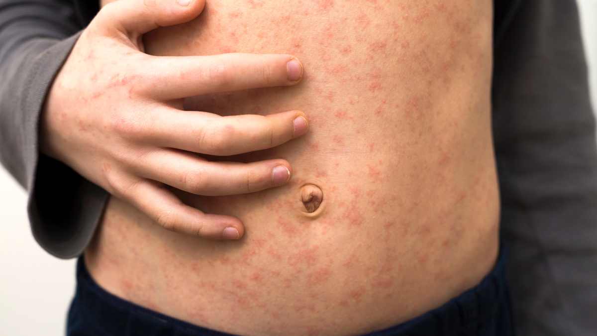 Quando fare il vaccino morbillo parotite rosolia?
