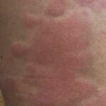 Rash from hives