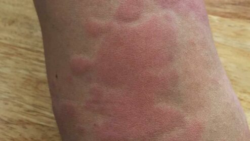 What is the best medicine to get rid of rashes?