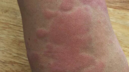 Rash from hives