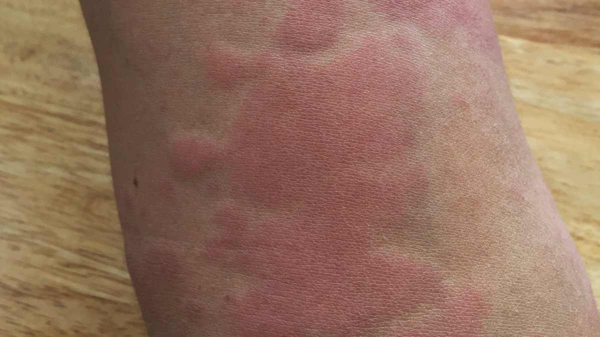 What is the best medicine to get rid of rashes?