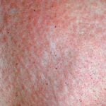 Rash on the skin. Very itchy