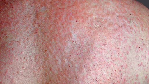 Rash on the skin. Very itchy