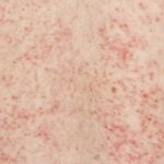 Rashes on Skin