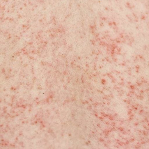 Random Disappearing Rash What is a rash that doesn't disappear under glass? - Torrinomedica