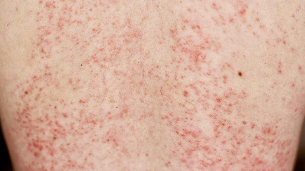 Will my rash go away on its own?