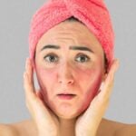 Woman face with skin irritation rash
