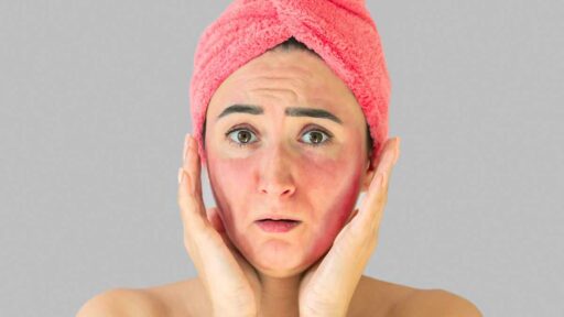 Woman face with skin irritation rash