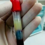 campione di siero contenente alti trigliceridi