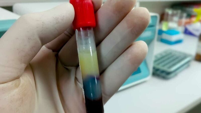 campione di siero contenente alti trigliceridi